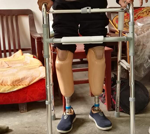 假肢对截肢患者的康复有哪些帮助？(图1)
