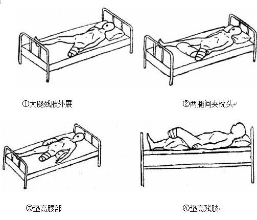 术后假肢装配的准备